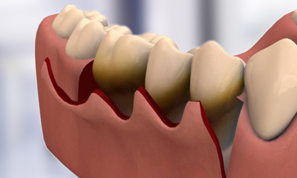 Gums Surgery (flap surgery) & Lasers